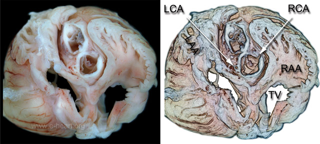 atrial appendages fetus